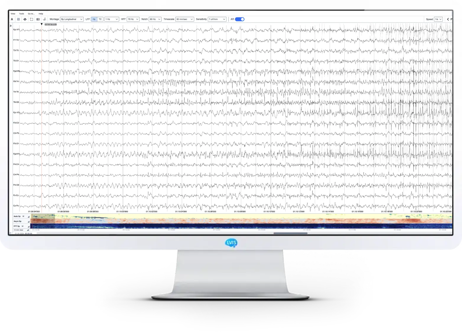 Monitor showing NeuroMatch software